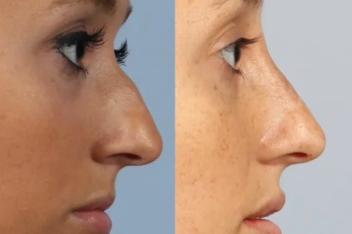 هر آنچه پیش از تزریق فیلر بینی باید بدانید