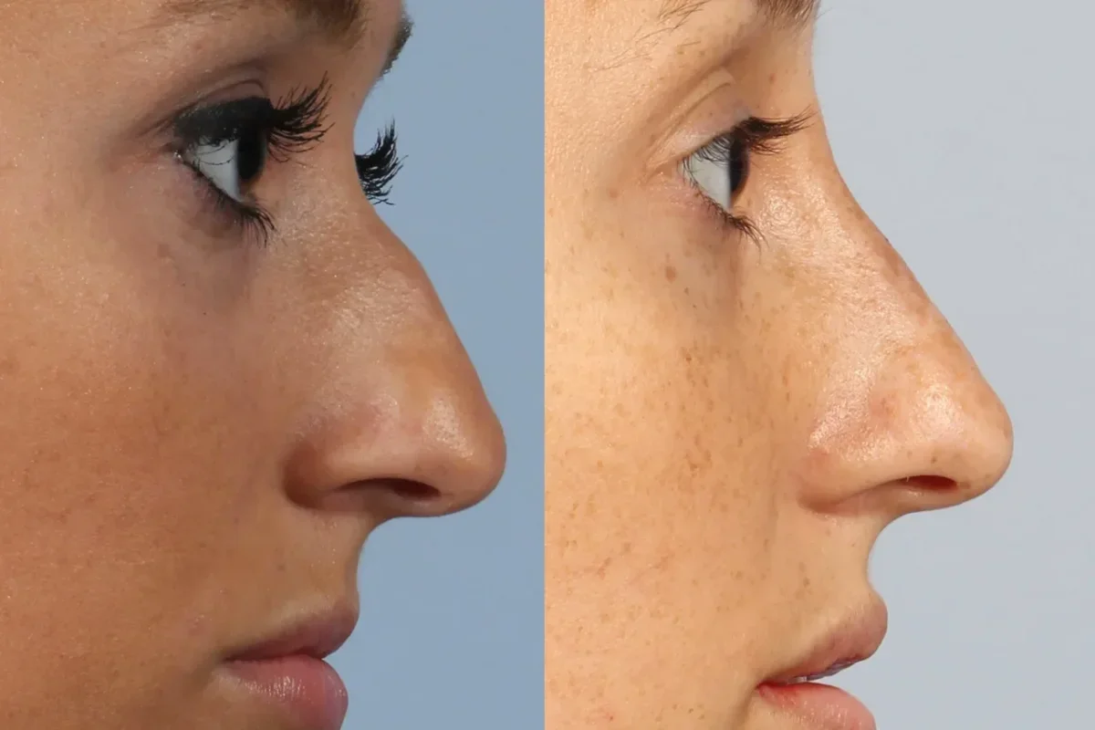 هر آنچه پیش از تزریق فیلر بینی باید بدانید